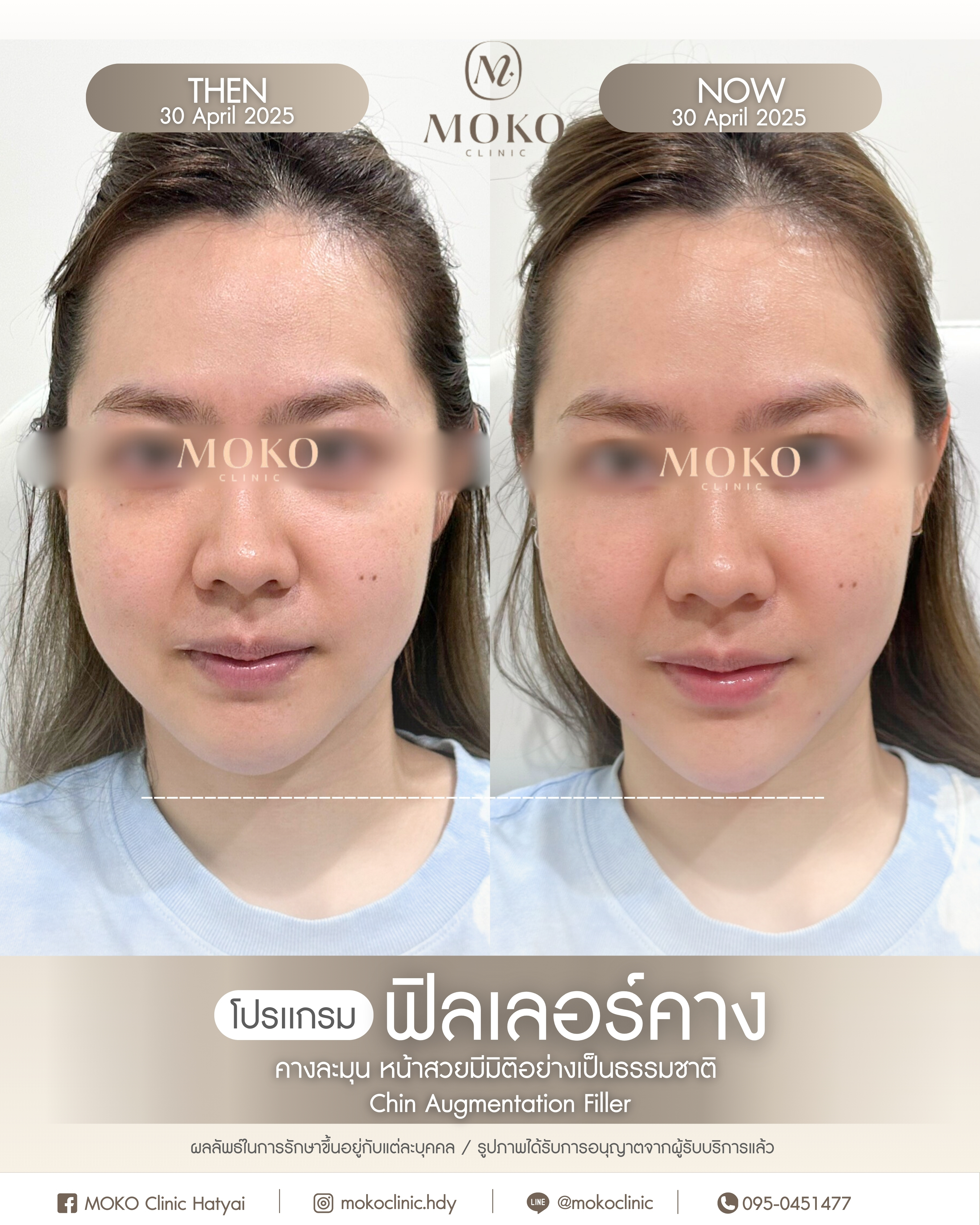 Before After Results 5