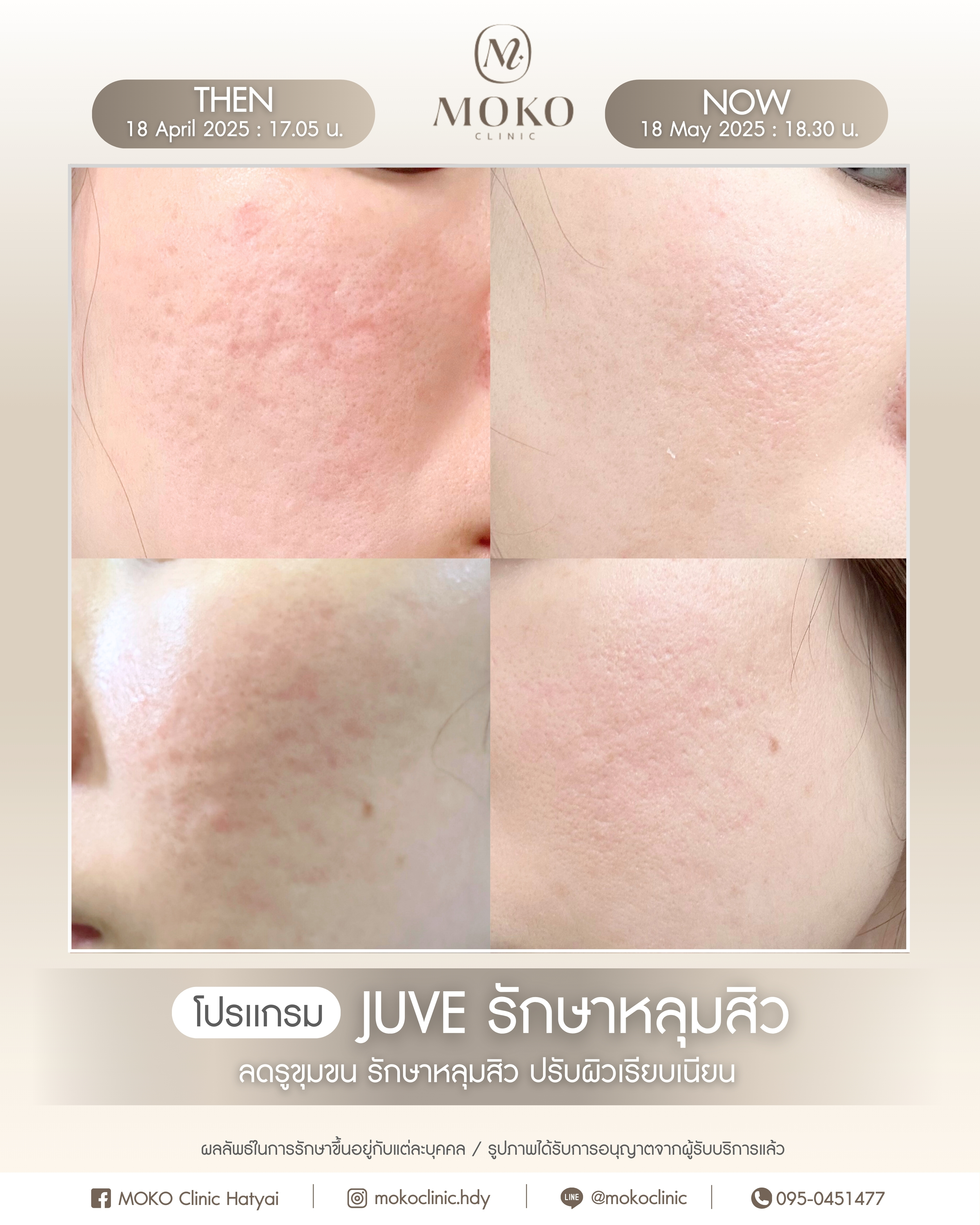 Before After Results 4