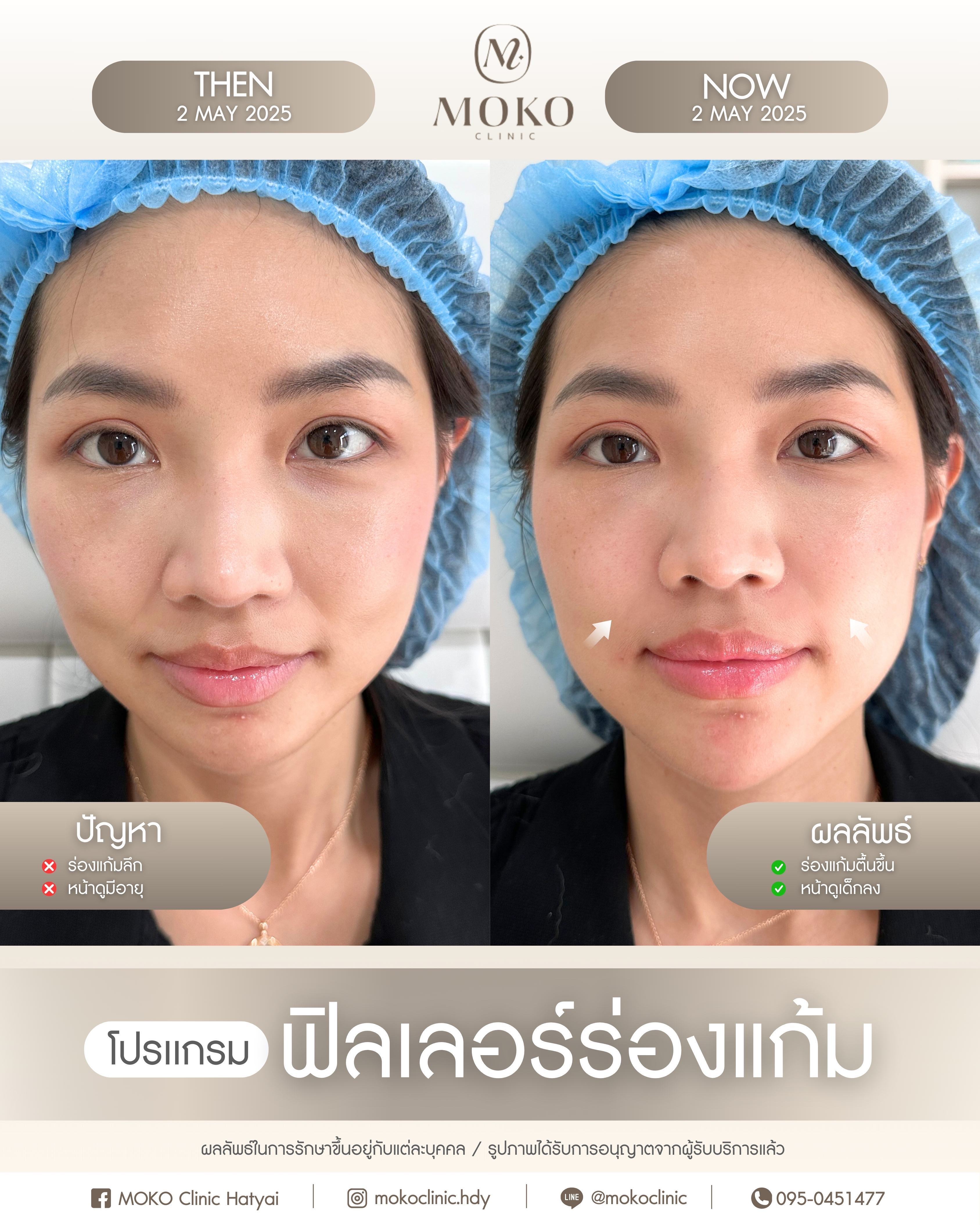 Before After Results 3