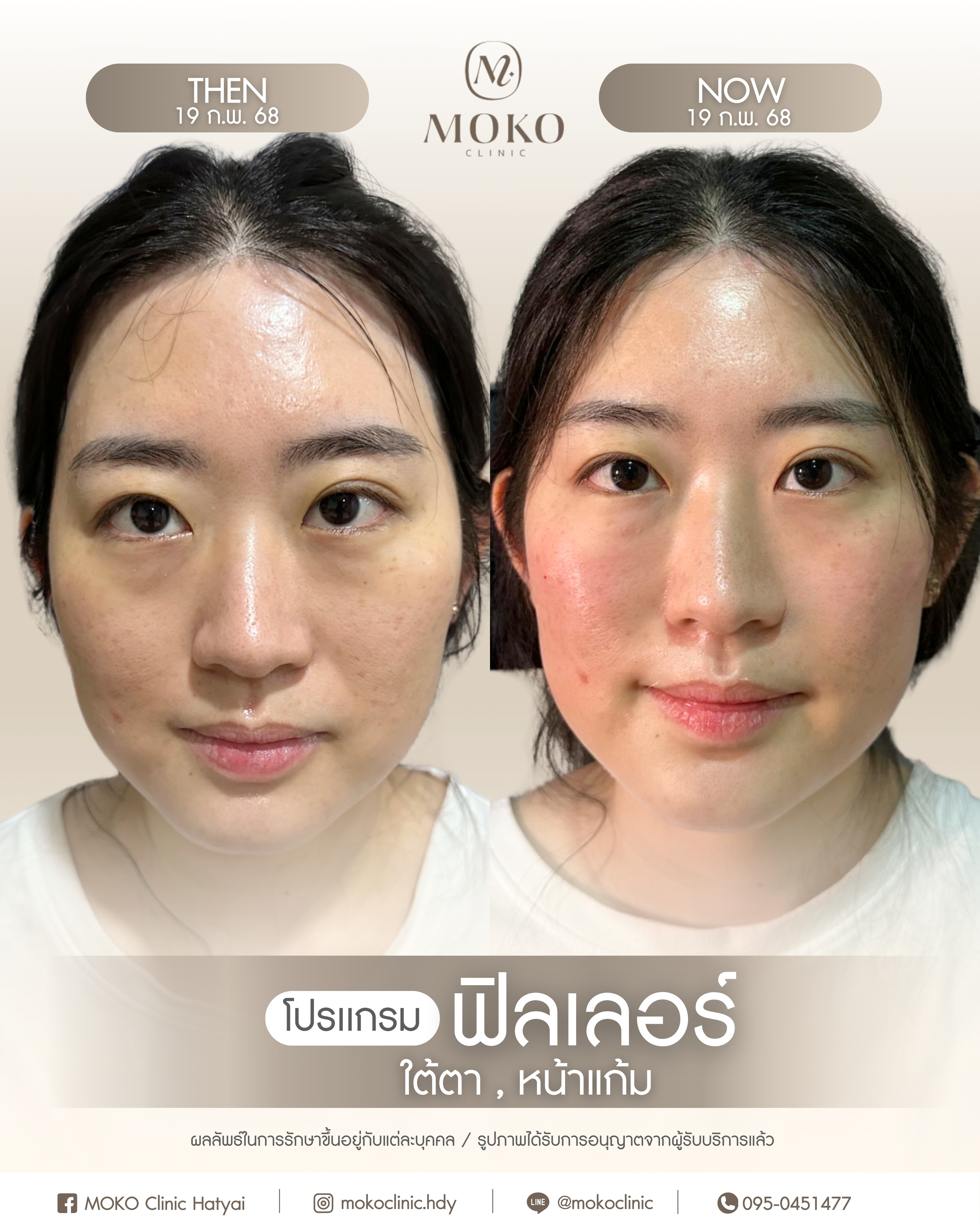 Before After Results 2